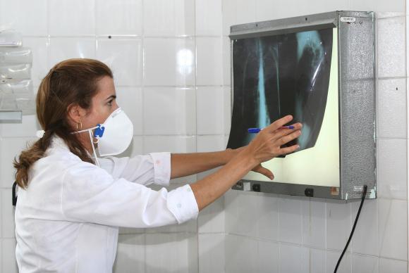 Anvisa aprova registro de novo medicamento para tuberculose